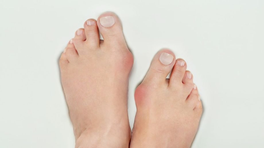 hallux valgus, bunion on woman foot