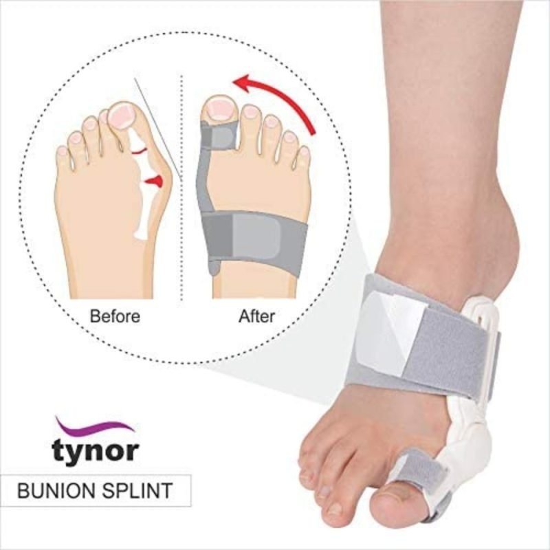 tynor bunion splint before after