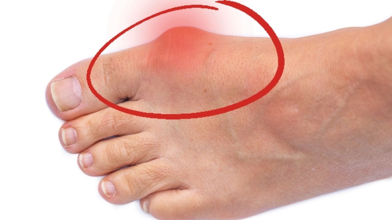 Alleviating Bunion Pain Comprehensive Guide To Treatment Options